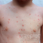 Obrázek #1, Jak předejít oparovým kožním infekcím?