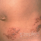 Obrázek #2, Jak předejít oparovým kožním infekcím?